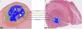 Crohn’s disease bowel scarring